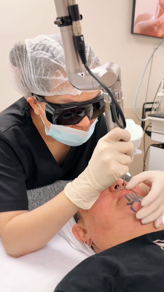 💁♀️Upper lip hair removal #longpulselaser #hairremoval #laserhairremovaltreatment