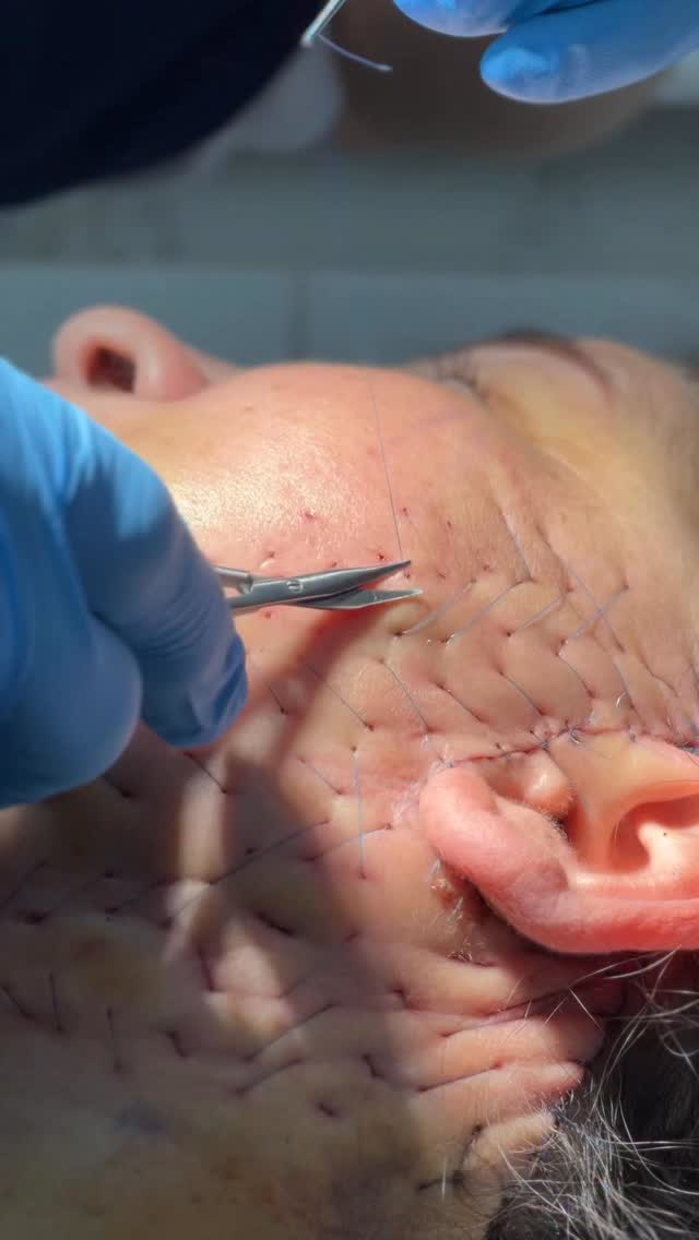 Retiro de malla hemostatica a tan solo 3 dias de evolución de un minilifting 😏 ¿y ustedes saben para que se usa la malla?