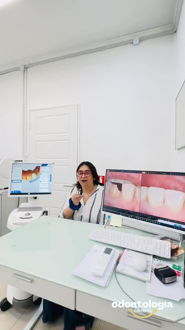 ✨
Hoy te mostramos un caso donde una paciente llegó con un diente fracturado por una caída y gracias a la tecnología CEREC, pudimos devolverle función y estética en una sola sesión.
🔹 Escaneamos digitalmente el diente
🔹 Diseñamos la restauración en 3D
🔹 Fresamos la cerámica en nuestra clínica
🔹 Cementamos la pieza… ¡y listo!
El resultado: una restauración cerámica, precisa, estética y duradera, hecha a medida y sin necesidad de múltiples visitas.
💙 Tecnología que cuida tu tiempo y tu sonrisa.
#CEREC #OdontologíaDigital #CoronasEnElDía #FlujoDigital #Cerámica #OdontologíaEstética #SonrisaEnUnDía #ClínicaDental #DentistaChile #curanilahue #dentistacuranilahue #clinicadentalcuranilahue #drvictorvarela