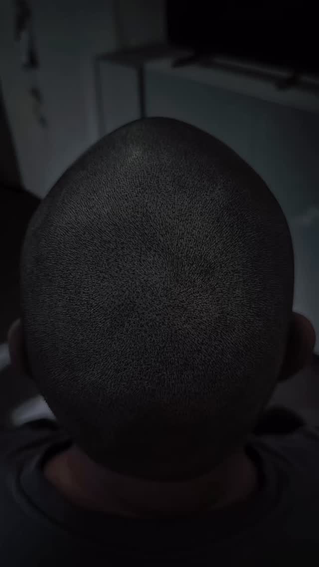 ✨ Haarausfall? Ich rette dich – sofort sichtbar. ✨
Wenn du denkst, du musst „damit leben“ – nein.
SMP (Scalp Micropigmentation) zeigt dir in Minuten, wie krass sich dein Look verändern kann.
Keine Wartezeit. Keine Heilungswochen. Keine Ausfallzeit. Nur direktes Ergebnis, das dich im Spiegel wieder lächeln lässt.
Meine Kunden kommen nach unzähligen Fehlversuchen: Öle, Shampoos, Vitamine, Streuhaar…
Doch die Wahrheit lautet: Erblicher Haarausfall stoppt nicht.
Aber: Er lässt sich perfekt kaschieren und das dauerhaft, natürlich und ohne OP.
In diesem Reel siehst du echte Ergebnisse:
🔹 dichterer Hairline-Look
🔹 sofortige optische Verdichtung
🔹 natürliche Übergänge, die niemand erkennt
🔹 mehr Selbstvertrauen ab der ersten Minute
Wenn du Haarausfall hast oder jemanden kennst, der damit kämpft:
👉 SMP könnte der Wendepunkt sein.
Lass uns sprechen – ich berate dich ehrlich, transparent und individuell.
💬 Schreib mir „INFO“ in die Kommentare und ich melde mich persönlich.
#ScalpMicropigmentation #potsdam #Haarverlust #Haarverdichtung