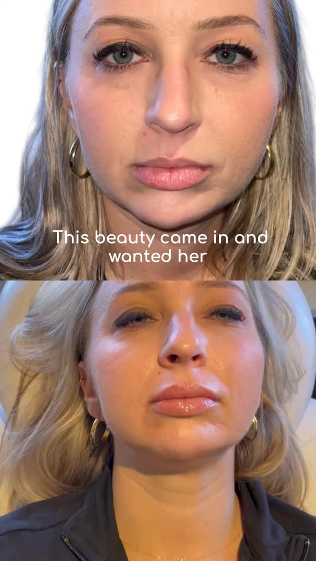 Lucious Lips by Handcrafted Aesthetics — beautifully balanced, naturally enhanced, effortlessly stunning. 💋✨
#HandcraftedAesthetics #LuciousLips #LipFiller #NaturalEnhancement #BeautyByDrPrince #ColumbusMedSpa #GahannaMedSpa #Aesthetics #BeforeAndAfter #LipGoals