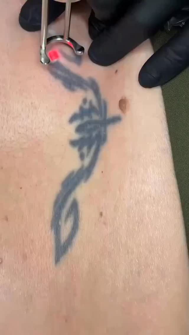 Old tattoos don’t have to stay with you forever if you don’t want them to!
Medical laser removal makes the process safe, effective, and so much easier than people think. Even older, faded, or deep tattoos can be treated — the laser breaks down the pigment without damaging your skin.
If you’re ready to finally let go of that old ink, I’m here to help you start fresh ✨
____________________________________________________
Permanent Makeup Services, Tattoo Removal & Carbon Laser Facial
⬆️Book apt with the link in bio
✨Free Consultation available
📍Oshawa, Ontario
✉️ browsbyieva@gmail.com
📱 +1 416-804-6749
Website: permanentbeautybyieva.com
#evolaser#tattooremovaloshawa#laserremovaltattoo#pmuremoval#oshawatattoo