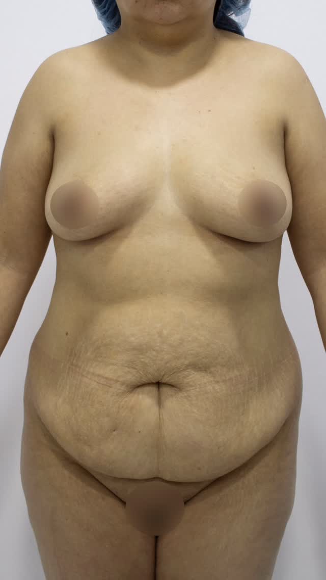 A 7 meses de una abdominoplastia el cambio es realmente precioso. La piel sobrante quedó atrás y el abdomen luce un contorno armonioso y definido ✨ un resultado digno de celebración!