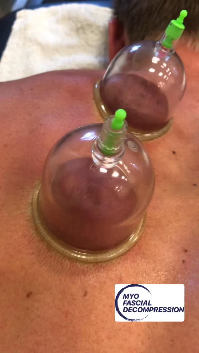 When tissues lose glide your movement loses efficiency, and your body starts compensating. Fix the glide, unlock mobility and performance. Save this for when your body starts feeling crunchy again.
⭕️
When we see craters like this, there’s some disruption (densification) to the fascia which is impairing the layers ability to slide and glide over one another. CupTherapy can help reduce this densification and restore the tissues sliding interface. Come learn the science with us. Imaging, research, and a system built on clinical reasoning and not just techniques. CupTherapy.com/courses
#beyondcupping #cuppingtherapy #myofascialdecompression