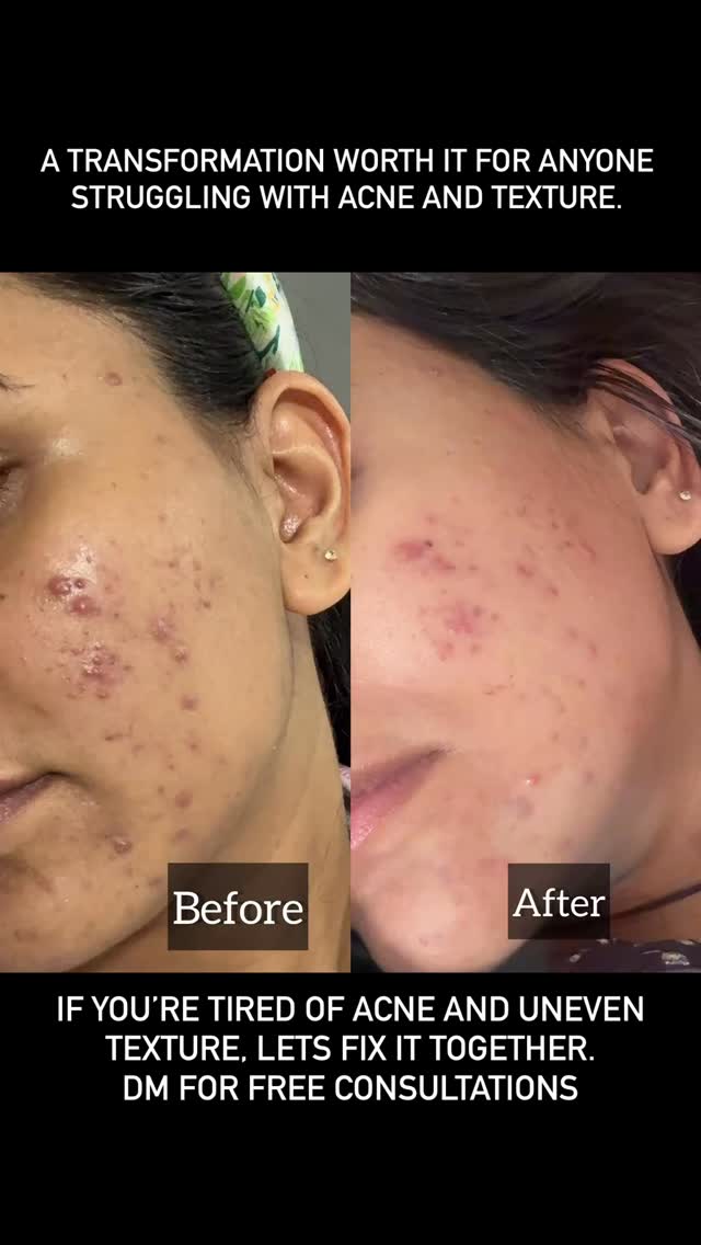 Acne-prone and uneven-texture skin can be frustrating, stubborn, and confidence-draining — but the right treatment plan can create real, visible change.
This transformation is proof that consistency, clinical care, and the correct protocol can completely reshape the skin: fewer breakouts, smoother texture, refined pores, and hydrated, healthy glow.
If you’re struggling with recurring acne, bumps, or dehydrated dull skin, you don’t have to keep trying random products or guessing what your skin needs.
A professional assessment and a customized treatment plan can help you achieve long-lasting, measurable improvement — and trust me, the results are always worth it.
Your transformation can be next.
Book your appointment or consultation to start your journey toward clearer, smoother, and more confident skin.
#SkinTransformation #AcneProneSkin #AcneTreatment #TextureImprovement #SkinClinic #ProfessionalSkincare #SkinHealth #ClearSkinJourney #SmoothSkinGoals #HydratedSkin #BeforeAndAfterSkin #ClinicalSkincare #AcneSolutions #SkinConfidence #HealthySkinStartsHere #SkincareResults #SkinHealing #GlowUpJourney #AestheticClinic #surrey #hauteesthetics #delta #canada #beautytreatment #antiaging #delta #skincaregoals #hauteesthetics