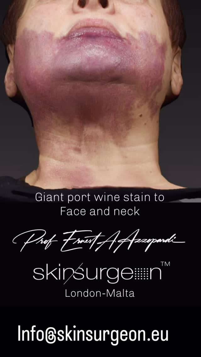 ✨ Transforming Skin, Restoring Confidence ✨
Today we share an extraordinary journey: the treatment of a massive congenital port wine stain in a mature patient who had lived with this condition her entire life.
Using advanced vascular laser platforms and a personalised, staged treatment plan, we’ve achieved dramatic lightening, texture refinement, and — most importantly — a profound boost in confidence and quality of life.
For many, port wine stains can feel untreatable. In expert hands, they are absolutely not. With today’s technology, meaningful improvement is possible at ANY age.
If you or someone you love has been told “nothing can be done,” it may be time for a specialist review.
Consultations by appointment
London & Malta
ONLY VIA 📧 info@skinsurgeon.eu
#SkinSurgeon #AestheticSurgery #ReconstructiveDermatology AdvancedSkincare MedicalAesthetics SolarisMT MaltaMedical MaltaAesthetics