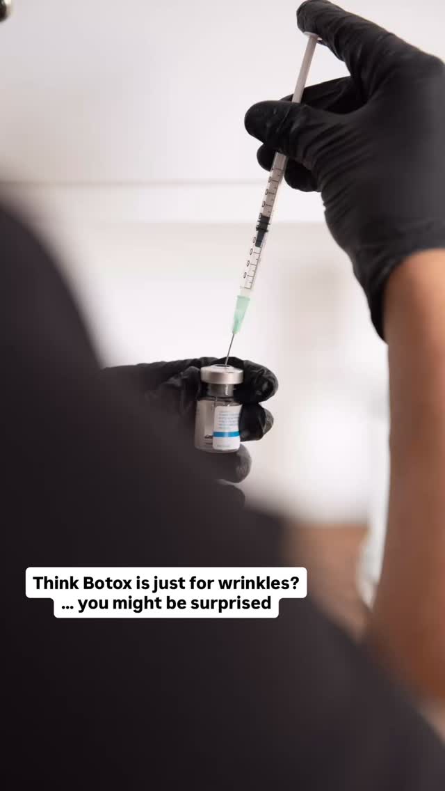 💉 Think Botox is just for wrinkles? Think again!
Botox isn’t just about smoothing forehead lines — it can target multiple areas. Here’s a breakdown in understanding about toxins:
✨ Common Areas:
• Forehead lines – smooth out those horizontal lines
• Frown lines (11s) – soften that “angry” look
• Smile lines – keep your expression natural while reducing lines
Other common areas:
• Masseters – slim the jaw & relieve tension
• Trap Botox – relax neck & shoulder tension
• Neck bands – smooth vertical lines for a youthful profile
• Underarms – control excessive sweating
• Gummy smile – subtle correction for a balanced smile
• Bunny lines – smooth nose wrinkles
• DAO (downturned corners of the mouth) – lift the corners for a happier expression
• Lip flip – enhance the upper lip without fillers
• Nasal tip – gentle lift for better nasal shape
• Chin wrinkles – soften those pesky lines
• Jawline tightening – define & sculpt
• Migraines – relief from chronic tension headaches
Botox isn’t one-size-fits-all — it’s customizable for both cosmetic and medical benefits!
Educational content. Not suitable for everyone. Consultation required.
𝖬𝗂𝖽𝗅𝖺𝗇𝖽 𝖠𝖾𝗌𝗍𝗁𝖾𝗍𝗂𝖼𝗌 𝖢𝗅𝗂𝗇𝗂𝖼 𝖢𝗈𝗏𝖾𝗇𝗍ry
✩ 𝖬𝖾𝖽𝗂𝖼𝖺𝗅 𝖯𝗋𝖺𝖼𝗍𝗂𝗍𝗂𝗈𝗇𝖾𝗋 𝖫𝖾𝖽 𝖠𝖾𝗌𝗍𝗁𝖾𝗍𝗂𝖼𝗌
✩ 𝖥𝗎𝗅𝗅𝗒 𝖨𝗇𝗌𝗎𝗋𝖾𝖽 𝖢𝗈𝗌𝗆𝖾𝗍𝗂𝖼 𝖢𝗅𝗂𝗇𝗂𝖼
✩ 𝖯𝗋𝗂𝗏𝖺𝗍𝖾 𝖺𝗇𝖽 𝖢𝗈𝗇𝖿𝗂𝖽𝖾𝗇𝗍𝗂𝖺𝗅
#Botox #BotoxTreatment #BotoxAesthetics #AntiAging #YouthfulSkin #WrinkleFree #FacialRejuvenation #ForeheadLines #FrownLines #SmileLines #JawlineBotox #MasseterBotox #NeckBotox #TrapBotox #UnderarmBotox #GummySmileCorrection #BunnyLines #LipFlip #ChinWrinkles #NasalTipLift #MigrainesRelief #SweatControl #AestheticMedicine #CosmeticInjections #GlowUp #SelfCare #ConfidenceBoost #LookGoodFeelGood