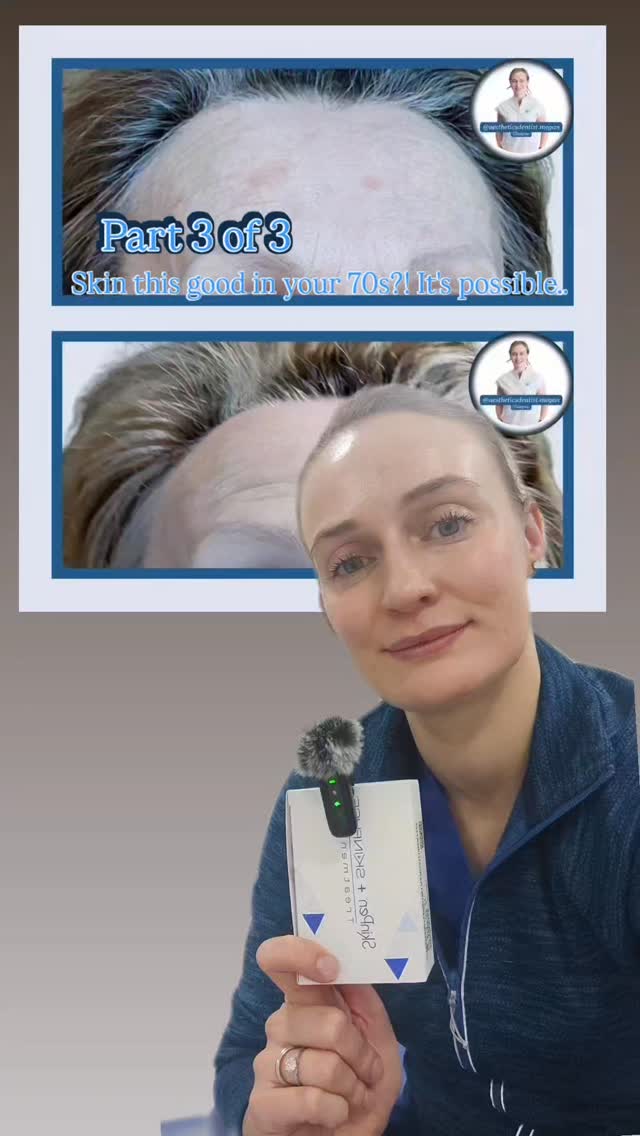 SKIN TRANSFORMATION part 3 of 3
The power of Microneedling and skin boosters and a little patience 💪
Healthy skin is always the goal! You could have as much Botox or fillers as you like but if it's not wrapped up in gorgeous, healthy skin you're missing out 💙
Invest in yourself. I'm here when you're reqdy
Megan x
Dentist led aesthetics and skincare in Glasgow