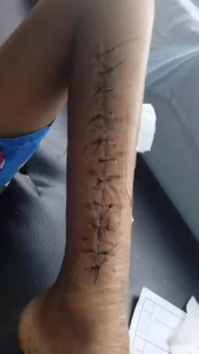 Alexander tiene 11 años y llegó desde Guasdualito después de una mordedura de serpiente que terminó en una fasciotomía. Su familia estaba lejos de casa, sin conocidos, sin recursos y con el miedo propio de una emergencia así.
Durante semanas lo acompañamos: laboratorios, alimentación, apoyo logístico y seguimiento médico continuo.
Gracias a todas las personas que sumaron —donantes, voluntarios y quienes compartieron sus casos— pudimos estar allí para él.
Hoy, Alexander vuelve a caminar. Y su familia, con lágrimas y gratitud, quiso compartir este pequeño milagro.
Si quieres ayudar a que más niños, adultos y familias reciban apoyo oportuno ante un accidente ofídico, puedes hacerlo aquí:
🔗 fundacionvivarium.org/dona
Tu apoyo transforma historias difíciles en caminos de esperanza. 💚#fundacionvivarium #preservandovidas #snake #venezuela #ayudahumanitaria