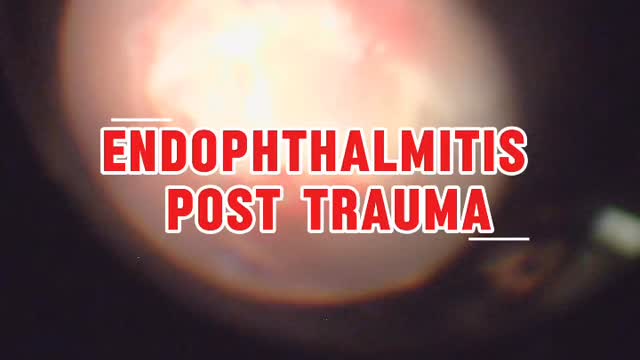 **Endophthalmitis Post Trauma**
This is a case of a patient presenting with endophthalmitis following an in/out injury with a probable wire foreign body in the eye.
The quality of the video is not great which shows how challenging endophthalmitis cases are as it is roughly what we see as well during the surgery and also a hint to upgrade our video camera system.
Technical explanation:
The case started out with a conjunctival peritomy and the site of scleral perforation was sutured closed. A vitreous biopsy followed by lensectomy and anterior chamber washout was performed to allow better visualisation of the retina. This video starts by showing the clearance of the vitreous opacities and the challenge was removing the posterior hyaloid which thankfully came off gently without causing a retinal tear. A localised area of haemorrhagic area on the retina superiorly was seen. The vitreous traction was relieved and laser performed around it. The eye was left aphakic. 1/2 dose intravitreal antibiotics was injected and silicone oil was inserted to tamponade the eye.
Shoutout to BMEC VR fellow @veleyesaris who was operating in this case as well!
#endophthalmitis #vitrectomy #vitreoretinal #eyetrauma #eyedoctorchng