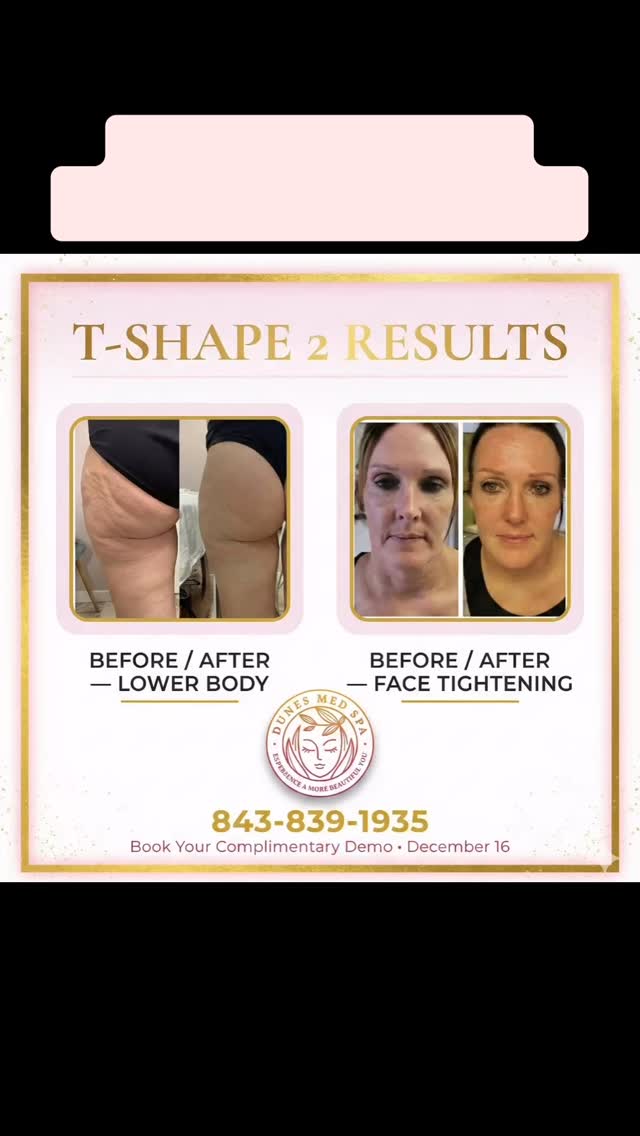 ✨ COMPLIMENTARY T-SHAPE 2 ✨
Monday – Saturday | 15th–20th
@DunesMedSpa
Experience the power of T-Shape 2 body & face contouring — on us.
💖 T-Shape 2 Benefits:
✔️ Tightens & firms skin
✔️ Reduces fat & cellulite
✔️ Lifts + sculpts face & body
✔️ Improves circulation & lymphatic drainage
✔️ Smooths texture & boosts collagen
✔️ Non-invasive • No downtime • Relaxing
🎯 Choose your complimentary area:
• Face
• Abdomen & Back
• Legs & Thighs (limited availability)
📍 Myrtle Beach
📞 843-839-1935
📆 Appointments required | Limited spots available
✨ See it. Feel it. Love it. #DunesMedSpa
#TShape2
#BodySculpting
#SkinTightening
#NonInvasive
#MedSpaLife
#AestheticGoals
#SelfCareLuxury