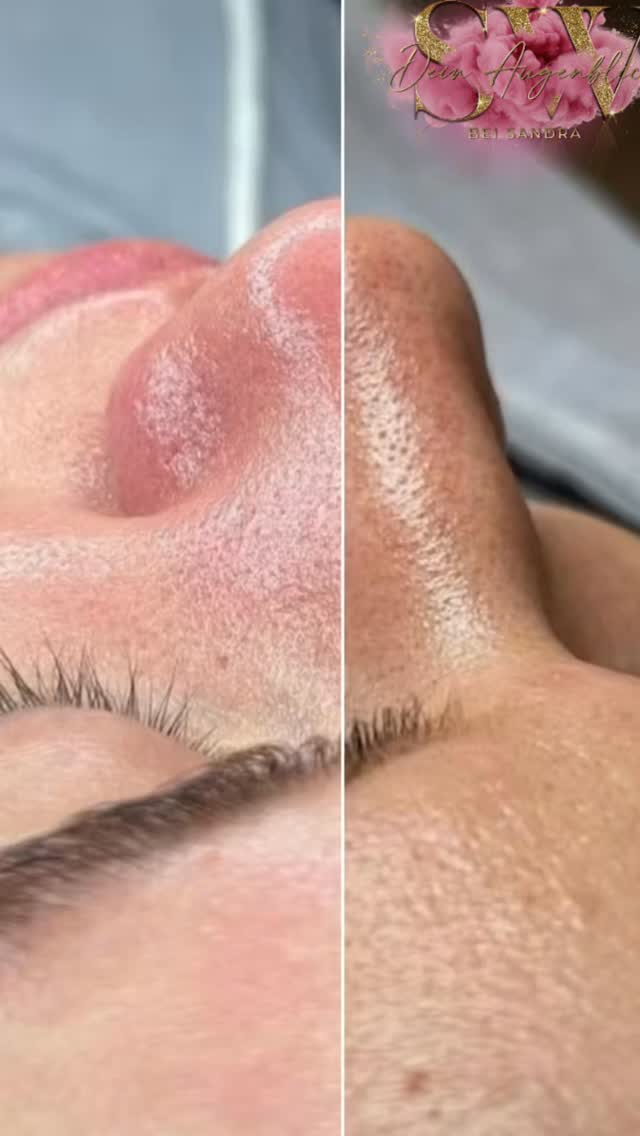 Aquafacial – porentief rein, ganz ohne Schmerzen ✨
Du wünschst dir eine tiefenreine, glatte und frische Haut – aber ohne Schmerzen?
Dann ist ein Aquafacial genau das Richtige für dich! 💧✨
Bei dieser Behandlung werden deine Poren gründlich gereinigt, abgestorbene Hautschüppchen gelöst und die Haut intensiv mit Feuchtigkeit versorgt.
Das Ergebnis: sichtbar klarere, feinere und strahlendere Haut – schon nach einer Anwendung.
💙 Sanft
💙 Schmerzfrei
💙 Porentief sauber
💙 Ideal bei verstopften Poren, fahler Haut & Unreinheiten
Buche jetzt deinen Glow-Moment in meinem Studio ✨
#aquafacial #facialtreatment #porenreinigung #hautpflege #skincaredeutschland #kosmetikstudio #cleanpores #glowyourself #skincarelover #gesichtsbehandlung #beautyroutine #vorhernachher #schmerzfrei #glowingskin #hydrafacialdupe #beautytrends2025 #kosmetikerin #beautycontent #skincarecommunity