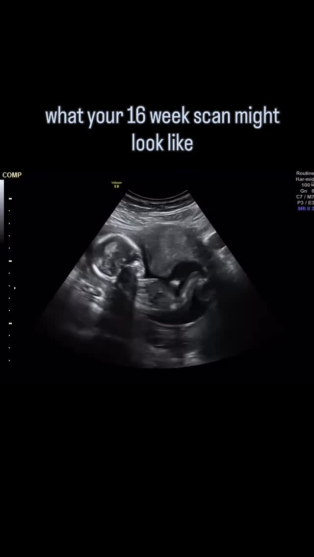 pov: your little one at 16 weeks✨
at your gender scan, you may see your little one wiggling about making themselves comfy! how amazing is this🫶🏼
book your Gender Scan today to see your little one🩵🩷
📍Nelson
#babyscanuk #gendereveal #16weekspregnant #secondtrimester #4dultrasound
