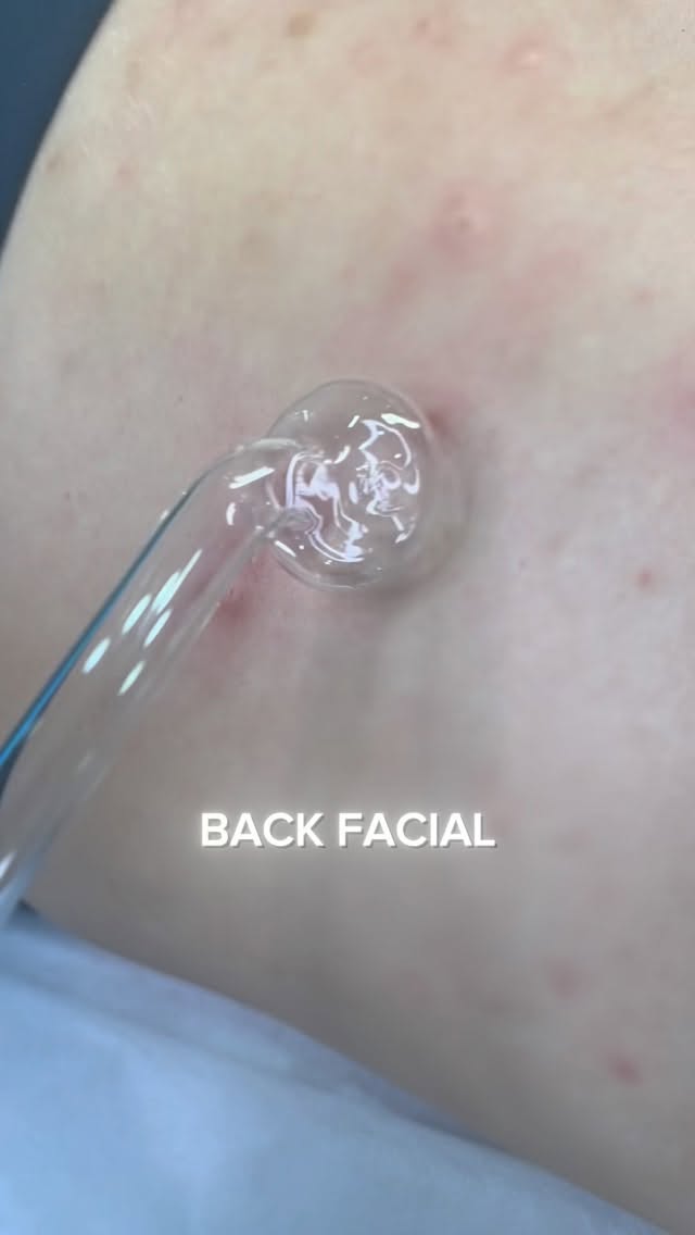 Plesová sezóna začíná. Pojďme si zkrášlit záda do šatů💃, ulevit je od pocení ve fitku 🏋️ a připravit je na období plavek. 🏊🏼♂️
Na zádech se toho množí i bez našeho dozoru, občasně nějaký ten nešvar nevědomky seškrábneme a ejhle, hned něco poskočilo o centimetr vedle.
🤌I póry na zádech se extrémně zanášejí, u někoho více, někde méně. Každopádně si tam nevidíme a často homemade extrakce končí jizévkami.
Hloubkovou extrakcí zad to začíná, peelingem pokračuje a případným mikrojehličkováním konče. 🩵
Extrahujeme všude, kde je potřeba. Záda, ramena, kolena, palce, kolena, palce, … 🎵🎶
#backfacial #akne #kosmetika #skincare #cistenipleti