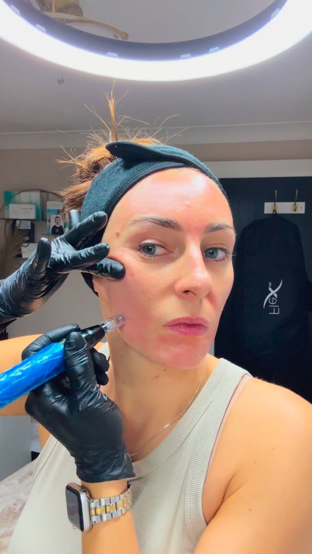 ✨ MICRONEEDLING…………….Why Everyone’s Talking About It ✨
If glowing, smoother, healthier skin is on your goals list… microneedling might just be your new best friend. 💫
Microneedling uses ultra-fine, medical-grade needles to create controlled micro-injuries—triggering your skin’s natural healing process and boosting collagen + elastin production.
The result? Long-term, natural rejuvenation from the inside out. 🧬
✨ Benefits of Professional Microneedling:
✔️ Stimulates collagen + elastin for firmer skin
✔️ Softens fine lines + wrinkles
✔️ Improves acne scars + texture
✔️ Minimizes pores
✔️ Evens skin tone + fades hyperpigmentation
✔️ Enhances product absorption
✔️ Gives you that “lit-from-within” glow 🔆
Professional treatments = controlled depth, precision, safety, and REAL results.
If you’re ready for skin that looks smoother, brighter, and more youthful—this is your sign. ❤️
Would you try microneedling? 👇✨
#Microneedling #SkinRejuvenation #CollagenBoost #ProfessionalSkincare #SkinTreatment #HealthySkinJourney #GlowingSkinTips #SmoothSkin #SkinTexture #HyperpigmentationTreatment #AcneScarTreatment #AntiAgingSkinCare #YouthfulSkin #SkinRenewal