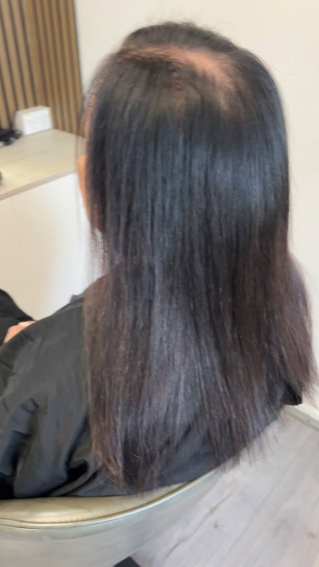 Come with us to Install a New Hair System 🌲
Today we installed this beauty, just in time for the Christmas Festivities!
This system is the Replica8 Injected PU Topper, which is snugly fitted to our clients head shape, and held securely in place with Medical Grade Hair Adhesive.
This is one of the life changing systems we have on offer in our clinic.
If your not to sure which system is right for you, DM us in 2026 and come have a chat with our girls.
Offering:
* Fine Hair Extension methods
* Nano bonds + Invisible wefts
* Micro Point Hair Grafting
* PU Toppers
* Replica8 Injected PU System
* Signature Scalp Hair System
* Semi Permanent Wigs
#trichologyclinic #womenshairloss #wollongonghairreplacement #hairextensions #longhair #healthyhair #hairloss