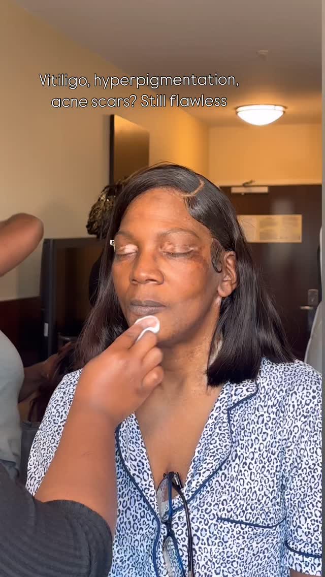 Absolutely. And not just vitiligo , hyperpigmentation, acne scarring, discoloration, rosacea… all of it can be beautifully and naturally enhanced with the right technique.
The real key isn’t whether makeup can work , it’s whether your artist has the skill set to give you the coverage, blend, and finish you’re looking for.
It’s not luck. It’s training, precision, and understanding skin.
Every face deserves glam that feels flawless and confident.
And yes… that includes YOU. ✨
Now booking 2026 Brides and Bridal parties, click the link in the bio or send a dm to inquire