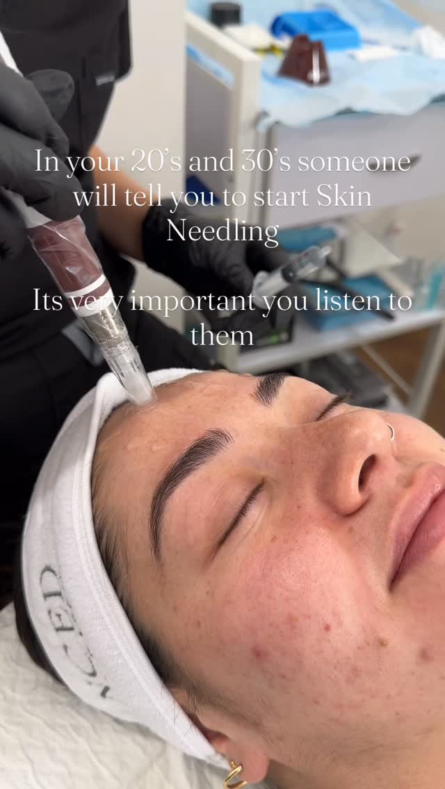 Skin needling = long-term skin investment.
This treatment creates controlled micro-channels in the skin, triggering your body’s natural healing response. That means fresh collagen, stronger elastin, and healthier skin structure over time, its not just a temporary glow.
Here’s why it matters:
✔ Collagen + elastin stimulation: From your mid-20s, collagen production starts to drop. Skin needling keeps those fibres active, helping maintain firmness and bounce.
✔ Smoother texture + reduced scarring: It breaks up old scar tissue and encourages new, healthier skin to form. Perfect for acne scarring, enlarged pores, and rough texture.
✔ Softens fine lines early: By improving skin thickness and elasticity, fine lines appear softer and form more slowly. Prevention > correction.
✔ Boosts product absorption: Those micro-channels allow active ingredients to penetrate deeper, making your skincare actually work harder.
✔ Healthy, long-term change: You’re not just treating the surface — you’re improving the way your skin functions at a cellular level.
Starting in your 20s and 30s means you’re supporting your skin before the visible signs of aging fully appear.
Consistent needling = stronger, clearer, firmer skin for years to come. ✨