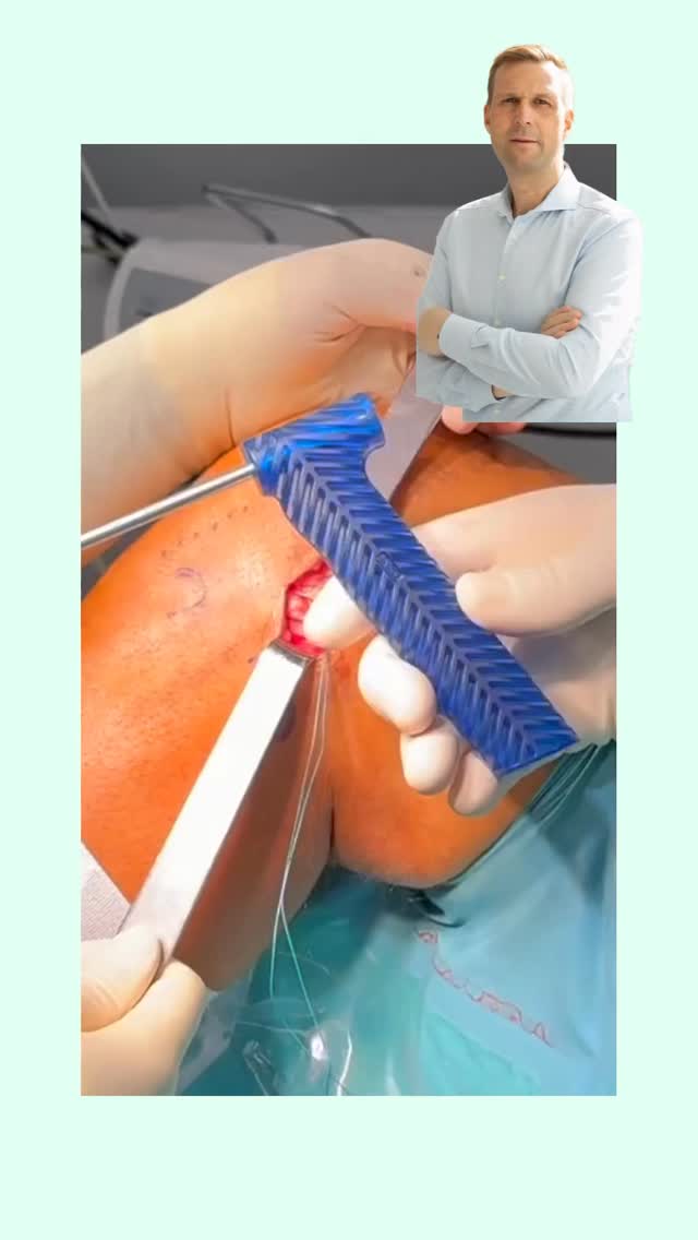 Anterolaterale Tenodese bei der Kreuzbandoperation ##knie #knieverletzung #knieschmerzen #arthroskopie #kreuzband #knieexperte #gelenke #operation #orthopaedie #knieoperation #profniemeyer #reha #rehabilitation #physio #arthrose #gonarthrose #meniskus #meniskusriss