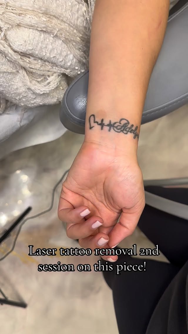 Laser tattoo removal! ⚡️⚡️
#tattooremoval #tattoo #lasertattooremoval