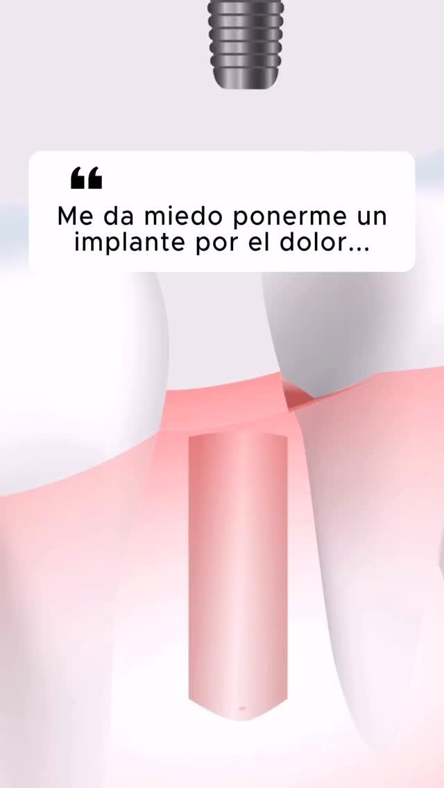 😟 “Me da miedo ponerme un implante… ¿duele?”
Es la frase que más escuchamos en consulta.
La realidad:
👉 Durante la intervención no hay dolor (se realiza con anestesia local).
👉 El postoperatorio suele ser mucho más llevadero de lo que imaginas.
👉 La mayoría de pacientes nos dicen después: “Si lo sé, lo hago antes.”
El miedo es normal.
La información y un buen equipo lo cambian todo.
💬 ¿Tú también tienes dudas o miedo a los implantes?
Escríbenos en comentarios 👇
#ImplantesDentales #SinMiedoAlDentista #ClínicaTresserra #CirugíaOral #dentistabarcelona
