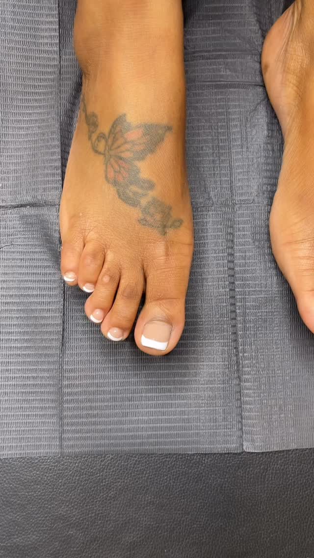 Toe Camouflage is a cosmetic tattooing procedure that uses skin-toned pigments to blend scars, calluses, or discoloration on toes into the surrounding skin, making them less noticeable and boosting confidence, especially for open-toe shoes.
As a skilled Paramedical Tattoo Artist, I custom-mix colors to match natural skin, implanting them using sterile needles, similar to micropigmentation, to hide marks from surgery, injuries, or conditions like hypopigmentation after corn removal.
HOW IT WORKS
1) Consultation: Assess the area and discuss goals.
2) Color Matching: Pigment is custom-mixed to perfectly match your skin tone.
3) Application: A digital machine and sterile needles implant pigment into the upper skin layers (dermis).
4) Sessions: Often requires multiple sessions (2-4) for best results, with touch-ups needed every few years.
BENEFITS
1) Creates a more uniform skin appearance on the toes.
2) Increases confidence in wearing sandals or open-toed footwear.
3) It’s a semi-permanent solution, lasting years with potential touch-ups.
Click the link in our bio for a Consultation or send us a picture to (832) 377-5677 OR info@beatandblade.com.
All pricing and details are available at BEATANDBLADE.COM
#toecamouflage #beforeandafter #houston #tattoo #tattoos #paramedicaltattoo #summer #travel #fyp