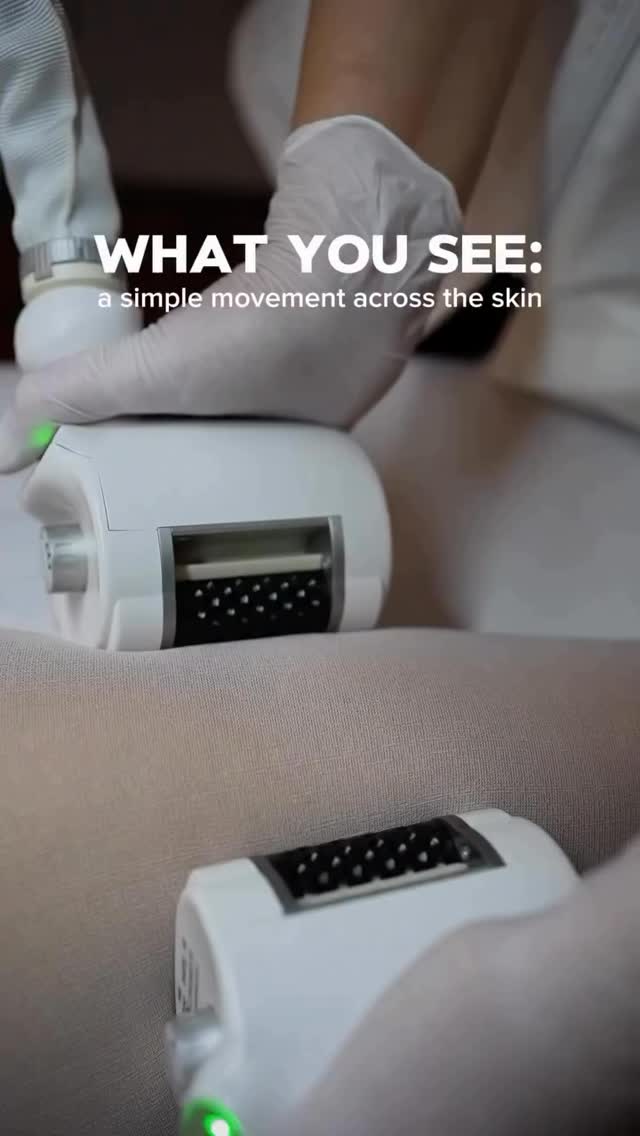 Du hast die Mikro-Details in Aktion gesehen, jetzt erklären wir dir, warum sie so wichtig sind.
Die Roboderm®-Technologie von Icoone ist nicht nur clevere Technik.
Sie ist ein komplett neuer Ansatz, das Gewebe zu behandeln.
Jeder einzelne Zug erzeugt tausende Multi-Mikrostimulationen, die:
• stagnierende Lymphe mobilisieren
• die Mikrozirkulation ankurbeln
• das Gewebe besser mit Sauerstoff versorgen
• die natürliche Kollagenaktivität unterstützen
• die Haut glätten, konturieren und entstauen
Und weil die Handstücke in 360° arbeiten, bekommt dein Körper eine gleichmäßige und präzise Stimulation, die manuell einfach nicht möglich ist.
Darum fühlt sich dein Körper schon nach der allerersten Sitzung leichter, straffer und definierter an.
Small details. Big changes.
Das ist die Power von Icoone ♥️