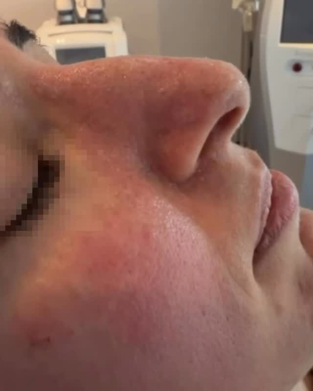 💉 Ενέσιμη ρινοπλαστική
Το προφίλ της μύτης σου αποκτά νέα ισορροπία ✨
Με υαλουρονικό οξύ υψηλού μοριακού βάρους, εξισορροπείται ο ύβος & το ακρορίνιο για ένα απόλυτα φυσικό αποτέλεσμα 🤍
✅ Ιδανική για μικρές ασυμμετρίες ή αν δεν είσαι ακόμα έτοιμος/η για χειρουργείο
⏳ Αποτέλεσμα που διαρκεί έως και 18 μήνες
⏱️ Γίνεται σε 15–20 λεπτά στο ιατρείο, με τοπική αναισθησία
📍 Athens | Limassol | Nicosia
📩 Κλείσε ραντεβού με DM ή:
🇬🇷 📞 210 7258982
🇨🇾 📞 96 444870
✉️ info@perfect-blue.com
🌐 www.dr-ektor.com
⭐️ Μόνο @drektor
#nose #drektor #viralvideos