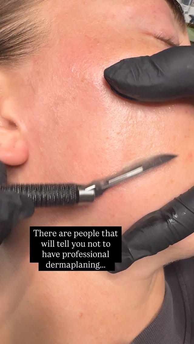 Dermaplaning MYTHS vs REALITY 👀
❌ Myth: It makes your hair grow back thicker and darker.
✔️ Reality: Your skin will GLOW like crazy.
Benefits you’ll LOVE:
✨ Instantly smoother, softer skin
✨ Brighter, more even complexion
✨ Better product absorption
✨ Makeup goes on like silk
✨ Removes peach fuzz + dead skin for that glass-skin finish
If you love instant results… this treatment is YOUR glow-up. 🏆
📍All services available in Birchington and Barham
Comment GLOW if you’ve tried dermaplaning!
#dermaplaning #glowingskin #skincaremyths #skincarebenefits #glassskin #facial