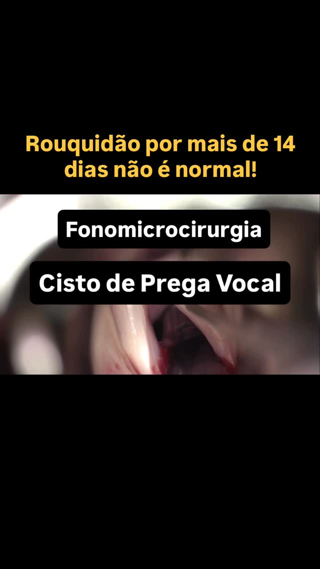 O cisto epidermóide de prega vocal causa rouquidão crônica devido à alteração da vibração mucosa e do fechamento glótico.
A fonomicrocirurgia tem papel central na eliminaçāo do mesmo, e é indicada quando o tratamento conservador, como a terapia fonoaudiológica, não resulta em melhora vocal satisfatória.
A excisão cuidadosa e completa do cisto, incluindo sua cápsula, preservando o epitélio e a lâmina própria, é a técnica padrão-ouro, pois reduz o risco de recorrência e de cicatrizes que podem comprometer a vibração da prega vocal.
A terapia fonoaudiológica pode e deve ser utilizada no pré e pós operatório para otimizar os resultados.
#voz #laringologia #laryngology #voicesurgery #voice #voicesurgeon