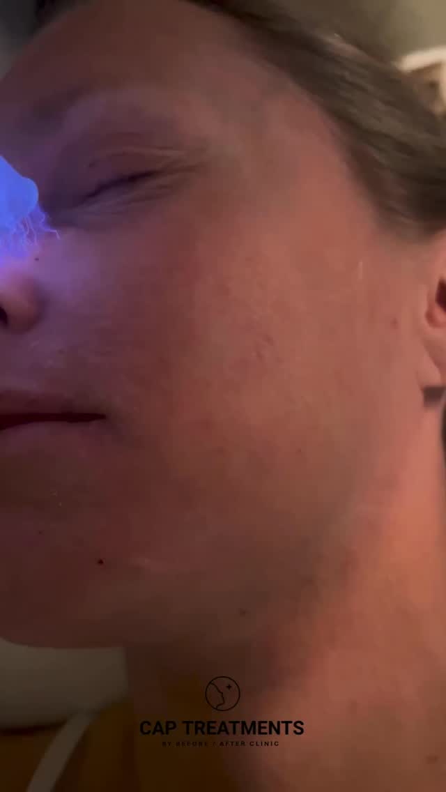 Många som genomgår TSW känner att det inte finns någon riktig hjälp. CAP-behandling lugnar inflammationer och påskyndar hudens återhämtning - helt utan steroider.
Boka tid för kostnadsfri konsultation 🌸
#tsw #eksem #thisisnoteczema