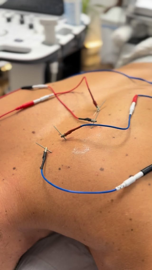 ¿Dolor muscular profundo y sólo has probado con terapia manual? ¿Perpetúan tus síntomas después de varias sesiones?
👉🏻 En Fisiotherapy Madrid contamos con las herramientas para ir un paso más allá:
🔬Ecografía
+
📌Fisioterapia invasiva (PENS, EPI, MC..)
Si quieres ir un paso más allá, tenemos lo que necesitas 😊
#fisioterapia #invasiva #ecografia