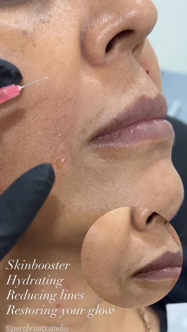 Treatment: Skin Booster
For more information or to book a consultation, contact us:
📱 343-451-7141
✉️ infoshaybloo@gmail.com
Video and photos were taken immediately after treatment. Redness and swelling are normal and will subside within a few days, with final results visible in about two weeks. Please note that lighting, angles, and skin tone can vary slightly in photos, but the focus is on the progress achieved.
#filler #ottawa #nurseinjectorottawa #toronto #lips #lipfillerbeforeandafter #lip #facialfillers