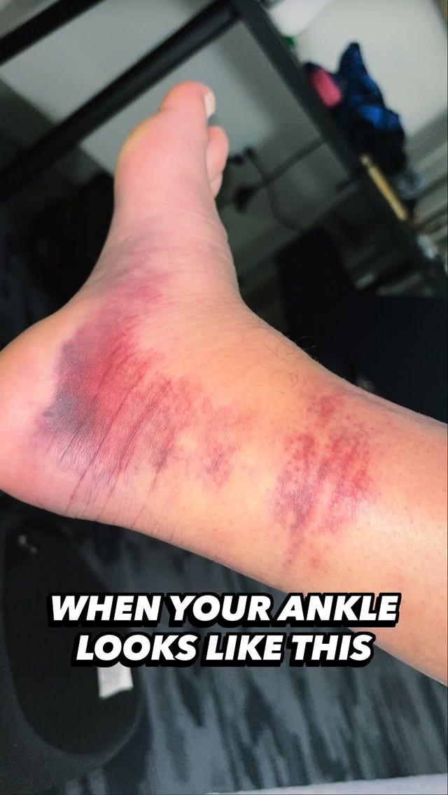 Injuries aren’t free passes not to put in the work. There is always something you can do