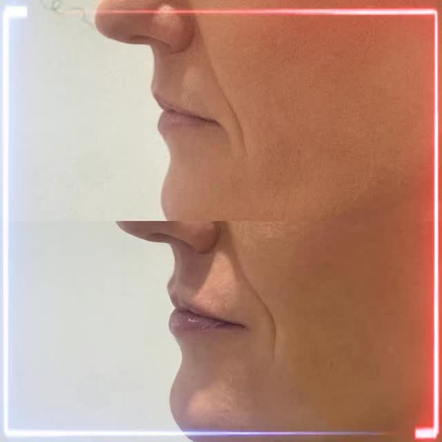 Subtle. Balanced. Beautiful 💋
This image captures exactly what we love about Teoxane Kiss — a soft, refined enhancement that respects your natural lip shape while adding just the right touch of volume and hydration.
No overfilling. No harsh lines. Just smoother texture, improved definition, and lips that look effortlessly healthy and kissable ✨
Perfect for anyone who wants enhancement that whispers, not shouts.
#TeoxaneKiss #NaturalLipEnhancement #SubtleResults #RefinedAesthetics #LessIsMore #LipConfidence