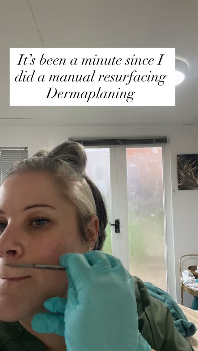 This is a great treatment if your skin is healthy 🤩
Not everyone is suitable to have this, trust me you would not thank me for causing micro rips in your skin, spreading bacteria and messing up your first line of defence against harmful factors.
My skin always feels so free, smooth and bright after this treatment .
Don’t worry if you are not sure if this is a suitable treatment, this will be discussed at your consultation.
My non negotiables for Dermaplaning
😱 I will not dermaplane over active acne
🤬I will not dermaplane of sunburnt skin
😤 I may not dermaplane on reactive. Sensitive skin- this will depend on my client’s willingness to prep their skin with my recommendations and commit to simple yet valuable aftercare
👌🏼I won’t offer this treatment if you expect this is a permanent hair removal treatment
I only ever work with good intentions.
This isn’t to scare you, I have treated many skins with no flare ups, breakouts or post treatment complications .
It’s about getting the balance 😜
If you’re looking for a glow up for your Xmas party I have a few appointments left.this really will make your foundation look flawless with that classy little glow with a silk finish!
DM to book last slots
Anna 🥰
#leightonbuzzardmums #leightonbuzzard #leightonbuzzardfacials #leightonbuzzardskinclinic #leightonbuzzardaesthetics #miltonkeynesmums #glowingskin #dermaplaningfacial #dermaplainingleightonbuzzard #peachfuzz #xmaspartyskin #smoothfoundation #