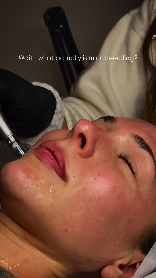 Letâs clear it up - because microneedling might sound scary, but itâs actually one of the most effective skin treatments you can get.
Microneedling (aka collagen induction therapy) uses a device with tiny needles to create controlled micro-injuries in the skin. Sounds intense, but itâs all very superficial - and your body loves it.
Why? Because those tiny injuries signal your skin to start repairing itself, fast. This triggers your natural production of collagen and elastin, which are the proteins responsible for keeping your skin firm, smooth and youthful.
Hereâs what it helps with:
- Acne scarring
- Fine lines + wrinkles
- Stretch marks
- Enlarged pores
- Pigmentation
- Dull or uneven skin tone
- Overall skin texture + elasticity
What does it feel like?
Not painful - most clients describe it as mildly scratchy or prickly. Youâll leave a little red (like a sunburn), but downtime is minimal.
What happens after?
Over the next few days and weeks, your skin goes into healing mode - regenerating, rebuilding and glowing from the inside out. Most people start seeing visible improvements after a few days, with results building over several weeks.
This isnât a quick-fix facial - itâs a long-term skin investment.
And if youâre serious about improving your skin, microneedling is a treatment worth understanding.
DM us to book or ask questions - weâre happy to help you figure out if itâs right for you.
#microneedlingcheltenham #skintransformation #collagenboost #nineteenbeauty cheltenhamskinclinic glowupfromwithin