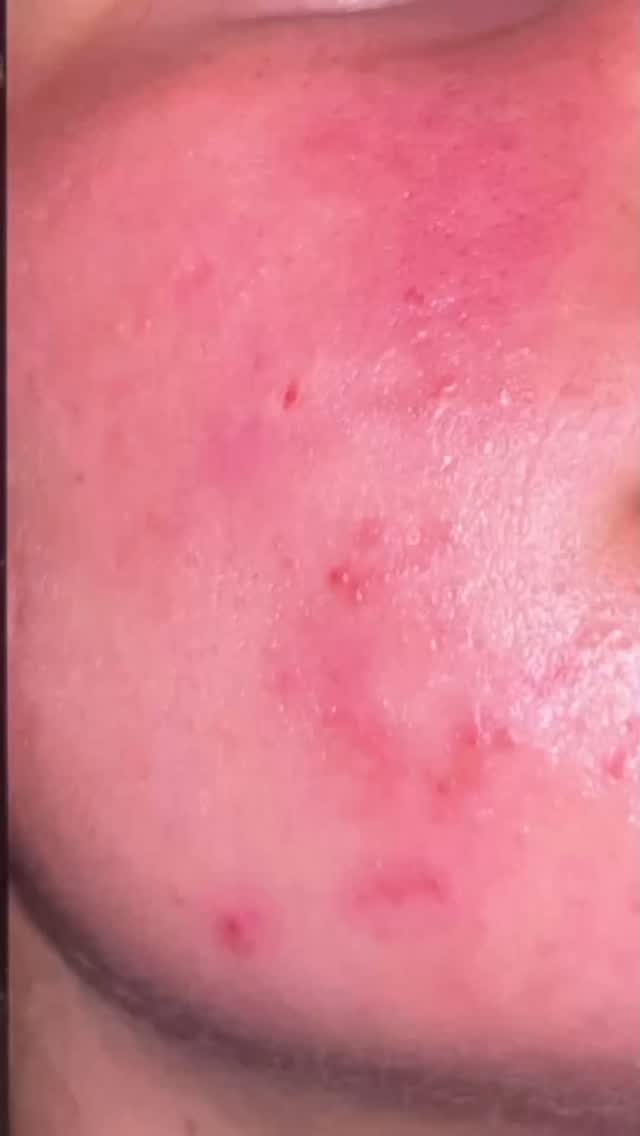 Acne is a confidence killer
It can make you want to disappear when the camera comes out!
It can be painful, sore, inflamed and a confidence crusher
If you are suffering I offer more than just products to help
We explore nutrition
Look at habits , lifestyle, stress levels and more .
These changes don’t come over night and I say this with love - if you’re not committed to the holistic plan it most probably won’t improve your acne.
The reality of changes can take 6-12 months , moving and adapting with support from me.
Kick acne to the curb in 2026
Let’s work together #leightonbuzzardmums #acne #adultacne #teenageacne #leightonbuzzard