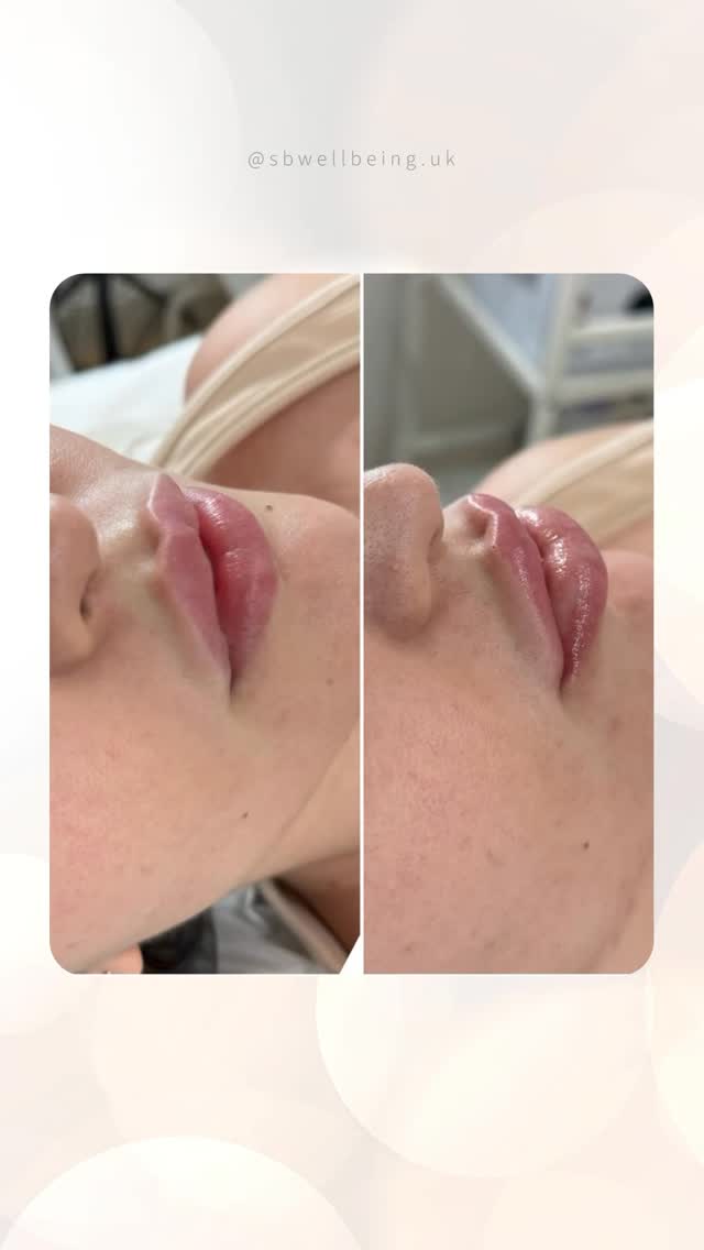 Encerrar o ano com tantos resultados assim é motivo de muita gratidão. ✨
Ao longo de 2025, tive a oportunidade de cuidar de muitas clientes especiais, que confiaram no meu trabalho e nos procedimentos realizados.
Cada antes e depois representa dedicação, responsabilidade e amor pelo que faço.
Meu agradecimento sincero a todas que estiveram comigo. 💖
Em 2026, sigo aqui para quem já cuida da sua beleza e para quem decide começar.
Vamos juntas? ✨💆♀️
.
Ending the year with so many results like these is truly something to be grateful for. ✨
Throughout 2025, I had the opportunity to care for many special clients who trusted my work and the procedures performed.
Each before and after represents dedication, responsibility, and love for what I do.
My sincere thanks to everyone who was with me. 💖
In 2026, I’ll continue to be here for those who already take care of their beauty and for those who decide to start.
Shall we go together? ✨💆♀️