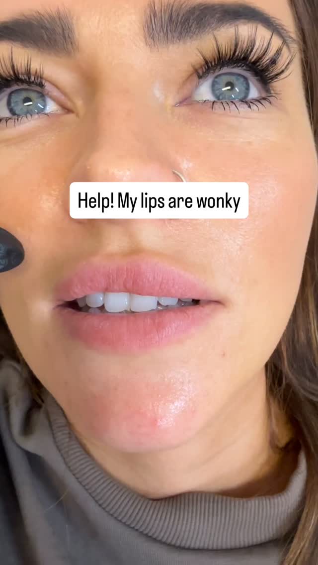 𝙊𝙪𝙩 𝙬𝙞𝙩𝙝 𝙩𝙝𝙚 𝙤𝙡𝙙, 𝙞𝙣 𝙬𝙞𝙩𝙝 𝙩𝙝𝙚 𝙙𝙤𝙡𝙡𝙚𝙙 💘
I absolutely love a lip makeover! This client was left disappointed after having her lips done elsewhere, so she took the plunge and dissolved.
It’s important to note that if you do go for a dissolve and refill it may take several sessions to reach your desired shape and size so patience is key 🗝️
*Intradermal patch test required, minimum of 2 weeks between dissolve & refill
Book a free consultation using the link in our bio