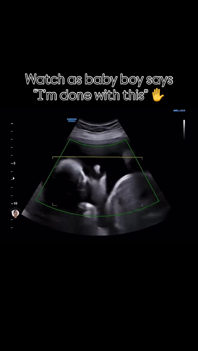 Watch as baby turns towards moms back 😂😍✌️
#pregnancy #pregnant #4dultrasound #reels #explorepage