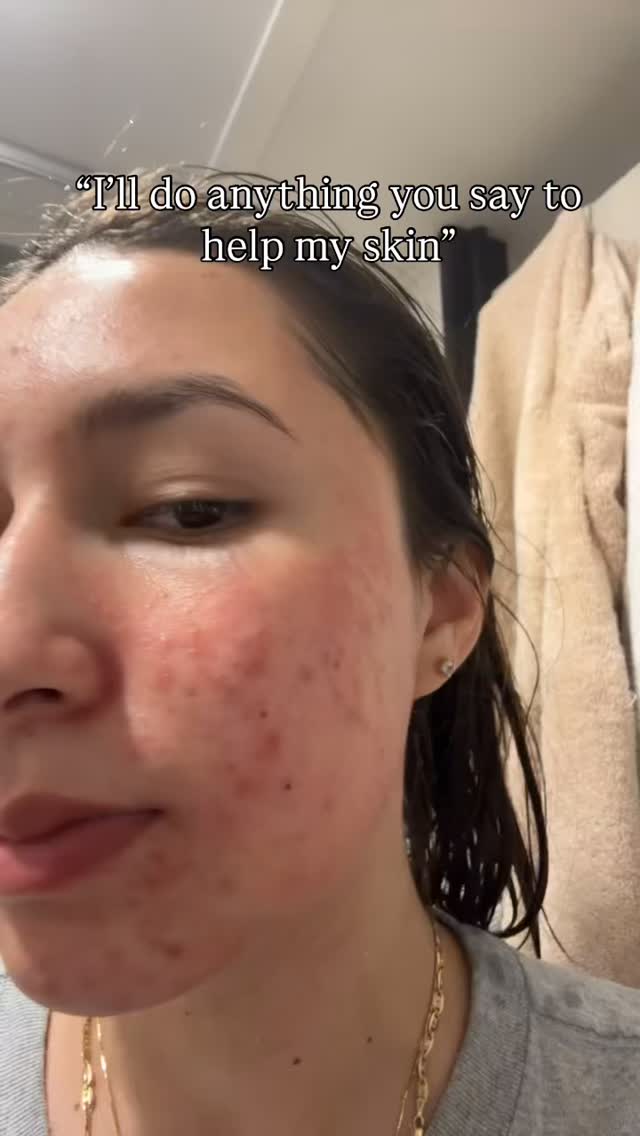 ✨ One year of skin progress ✨
Consistency > perfection every single time.
This transformation happened over a full year and yes, we even had a 3–4 month hiatus from in-studio treatments 👀
But because she stayed consistent with her homecare, her skin never fell off track (this is your sign that homecare actually matters).
In-studio treatments included:
@dmkinternational Enzyme Therapy
@elainebrennanskin Micropeel
Maintenance homecare that did the heavy lifting:
• Deep Pore Cleanser
• Super Bright Cream
• NutraScreen Sunscreen ☀️
Skin is a long game and when you commit to the process, the results speak for themselves ✨
#pearlessencebeauty #skinprogress #realresults #dmkskincare #elainebrennan skinjourney estheticianapproved consistencymatters skintransformation