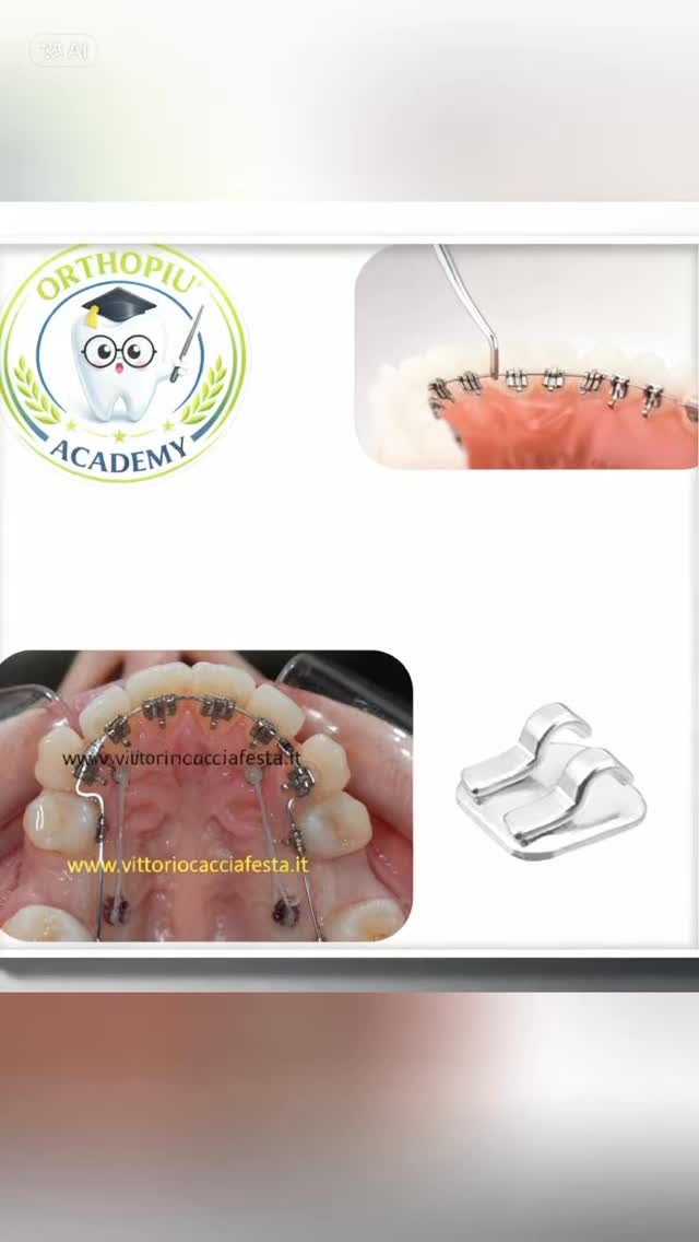 👉 CORSO FORMATIVO AVANZATO DI ORTODONZIA LINGUALE
“Come ottenere di più dai brackets 2D”
📍 Firenze – 7 marzo
🎓 Dr. Vittorio Cacciafesta
⏰ Quota agevolata disponibile solo fino a oggi
Iscriviti ora
#ortodonzia #ortodonzialinguale #lingualbraces