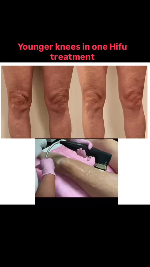 #sarasotaflorida #hifu #hifusarasota #sarasotamedspa #siestakeybeach