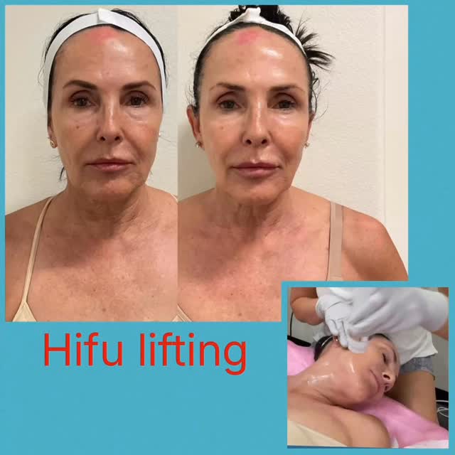 #sarasotawomanownedbusiness #sarasotamedspa #hifu #capricebeautybar #siestakeyflorida