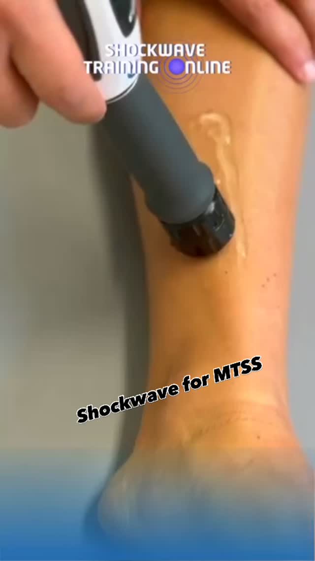 ⚡ MTSS (shin splints): Why shockwave therapy should be in your clinical toolkit
Medial Tibial Stress Syndrome is a challenging, load-related condition that often becomes persistent despite exercise-based rehab alone. For therapists managing runners, field sport athletes, and tactical populations, shockwave therapy can be a valuable adjunct when applied with the right clinical reasoning.
🔬 Why shockwave for MTSS?
✔️ Stimulates osteogenic and soft-tissue healing at the tibial cortex
✔️ Increases local circulation and metabolic activity
✔️ Modulates pain via neurophysiological mechanisms
✔️ Helps break the chronicity cycle in recalcitrant cases
✔️ Supports progression back to load and impact when paired with rehab
Used appropriately alongside load management, strength programming, biomechanical assessment and orthotic intervention, shockwave can significantly enhance outcomes in stubborn MTSS presentations.
🎓 Learn how to apply shockwave therapy with confidence
Our online Shockwave Therapy course is designed specifically for therapists and covers:
• Clinical reasoning & patient selection
• Evidence-based protocols
• Practical application & parameters
• Integrating shockwave into rehab plans
Build confidence, improve outcomes, and elevate your clinical practice.
#ShockwaveTherapy #MTSS #ShinSplints #SportsPhysio #PhysioEducation TherapistTraining ClinicalReasoning EvidenceBasedPractice RunningInjuries LoadManagement RehabProfessionals OnlinePhysioCourse Physioimpulse