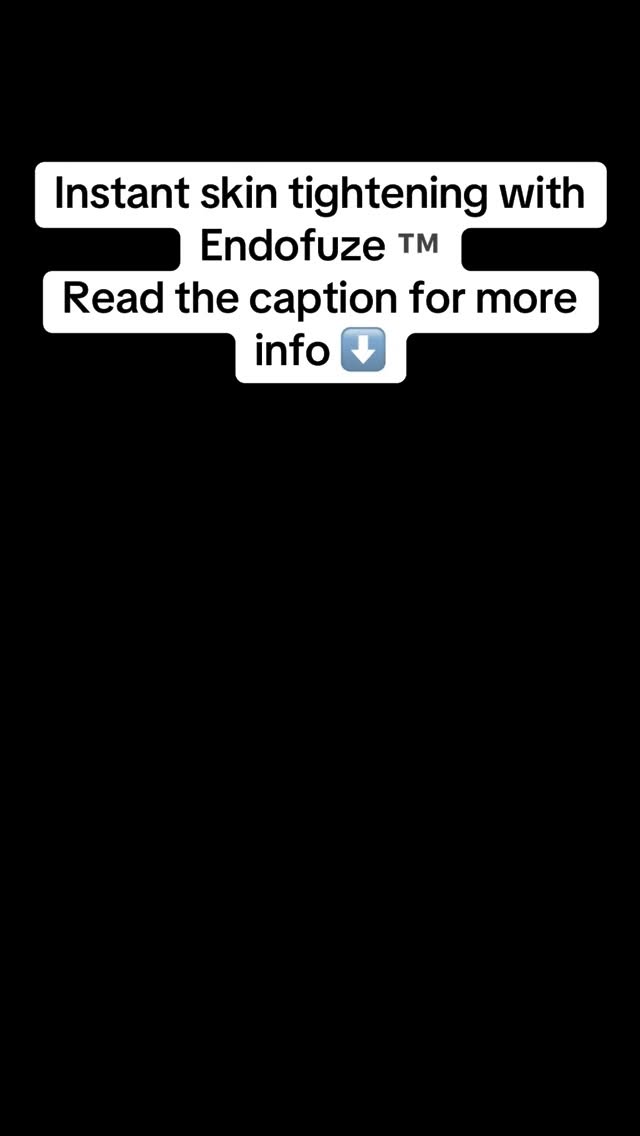Look closely 👀
Left side → untreated skin
Right side → immediately after EndoFuze™
Same stomach. Same pressure. Same moment in time.
The difference you’re seeing isn’t swelling or camera tricks — it’s tissue response.
The lower stomach is one of the hardest areas to tighten.
That crepey texture? That’s collagen loss and reduced elasticity — and it doesn’t bounce back on its own.
EndoFuze works by heating and contracting the deeper tissue, stimulating collagen and giving instant tightening, with continued improvement over the weeks that follow.
This is why clients love it — you can see and feel the change straight away.
⚠️ Limited availability
✨ High-demand treatment
📩 DM FUZED if you want to book xx #endolift #endoliftderby #endolaser #aestheticsderby #aestheticsnottingham