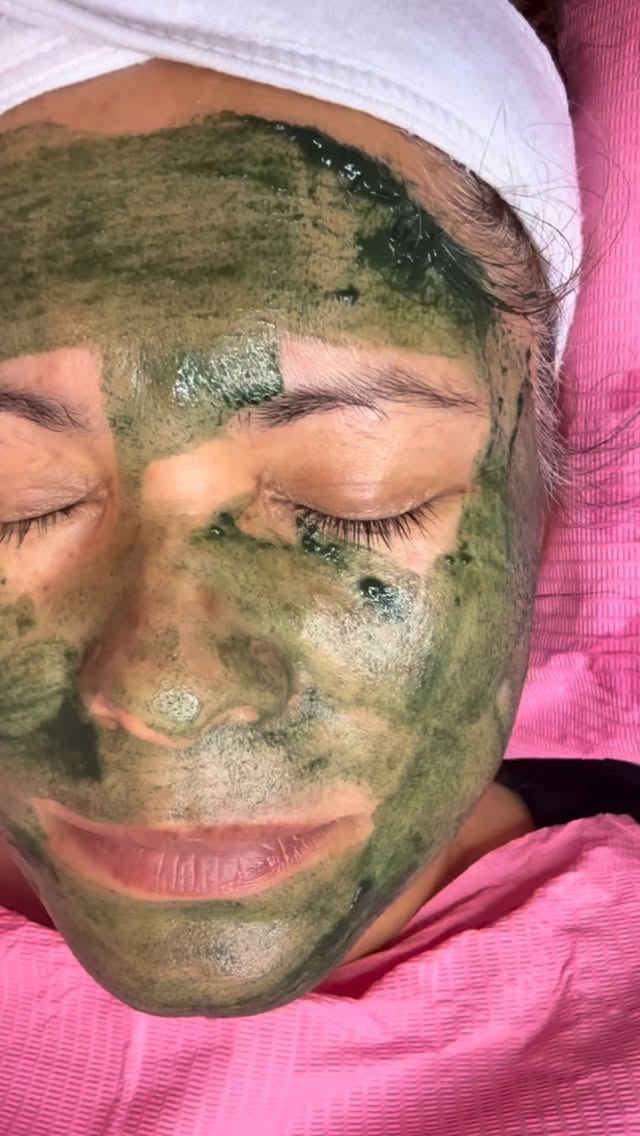 Green Sea Peel AKA Microneedling #First treatment for her helps for dark spots, hyperpigmentation, Melasma, Fine Lines, Acne