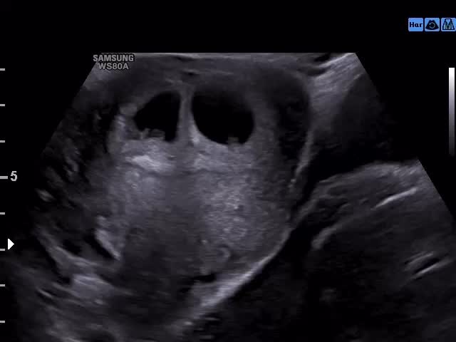 Built in besties 👯💕 6 weeks + 4 days
#pregnancy #twinsies #ultrasound #baby ultrasonido