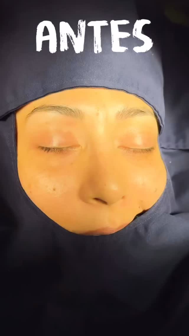 🔹 Observa cómo la forma y simetría cambian al instante. Recuerda que la inflamación es parte del proceso, ¡pero el cambio es evidente! Pregunta por tu valoración.
🔹Resultado inmediato Rinoplastia Estética y Funcional.
🔹 Gracias a mi excelente paciente por su confianza y permitir compartir su resultado.
🔹”Made by hand. Crafted with passion”
🧑⚕️ Dr. Guillermo Guerra Gil de Leyva
🏥 Hospital Ángeles Valle Oriente
📱 81-1252-0132
🎓Universidad de Monterrey
👃 Rinoplastia Estética y Funcional
🚫 No taponamiento
Cédula Profesional: 3070499
Cédula Especialista: 4503273
No. Certificación CONACEM: GUG-1748/04
Aviso de Publicidad COFEPRIS: 2419032002A00111
❕Paciente autoriza difusión de imágenes con fines académicos e informativos.
❕Los resultados finales se pudieran observar hasta un año de la cirugía y dependerá tanto del compromiso del cirujano como del paciente, así como del tipo de cirugía, tipo de piel, cuidados post-operatorios, etc.
#RinoplastiaEspecializada
#rinoplastia #rhinoplasty #nosejob
#belleza #confianza #autoestima
#cosmeticsurgery
#otorrinolaringologiamonterrey #otorrinomonterrey #beforeandafter #antesydespues
#rinoplastiaultrasonica
#ultrasonicrhinoplasty